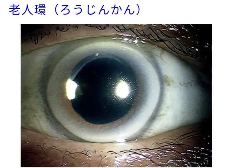 和泉伸二にも疑惑がある、老人環の症例画像