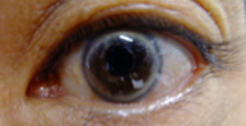 脂質異常症の患者の目の症状