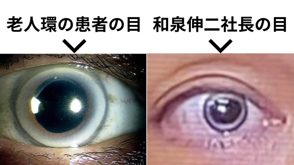 カラコン疑惑があるビッグモーター新社長の和泉伸二と老人環患者の比較