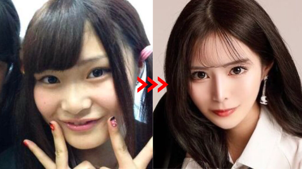 美少年のメンバー金指一世の彼女、キャバ嬢瞳の整形前と現在の顔の比較画像